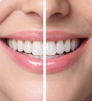 Dental Veneers
