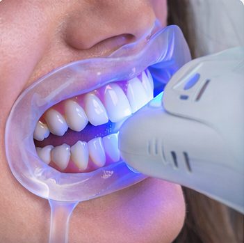 Teeth Whitening